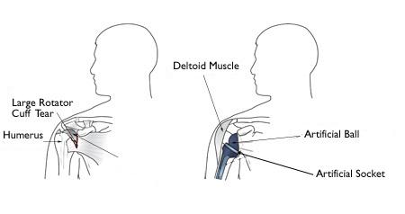 (Sinistra) Artropatia da cuffia dei rotatori. (Destra) La sostituzione totale di spalla inversa consente ad altri muscoli - come il deltoide - di fare il lavoro dei tendini della cuffia dei rotatori danneggiati.