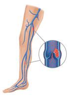 Coaguli di sangue si possono formare nelle vene delle gambe o del bacino.