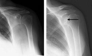 (Sinistra) Radiografia di una spalla sana. (Destra) Artrosi di spalla. Si noti la spazio articolare diminuito nella radiografia di destra (freccia).