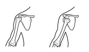 Sinistra: Anatomia normale della spalla. Destra: Testa dell’omero lussata anteriormente alla glenoide.