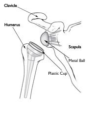 Le componenti di una protesi inversa di spalla includono la palla di metallo che viene avvitata nella glenoide e la tazza di plastica che è fissata nell'osso del braccio.
