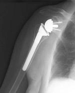 Una radiografia di una protesi inversa di spalla.