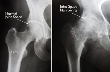 (Sinistra) In questa radiografia di un'anca normale, lo spazio tra la sfera e la cavità dimostra uno spessore di cartilagine sana. (Destra) Questa radiografia di un’anca artrosica mostra una grave perdita di spazio articolare.