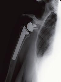 Una tipica radiografia di controllo di una protesi totale inversa di spalla.