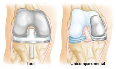 In una sostituzione parziale del ginocchio, solo il compartimento danneggiato viene sostituito con un dispositivo artificiale.