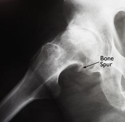 Questa radiografia mostra un grande sperone osseo che si è sviluppato sulla sfera di un’anca artrosica.