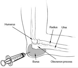 Il medico può rimuovere il liquido dalla borsa gonfia diverificare la presenza di infezione, o per preparare la borsaper una iniezione di corticosteroidi.