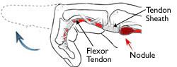 Il nodulo ispessito sul tendine flessore colpisce il tunnel, rendendo difficileraddrizzare il dito.