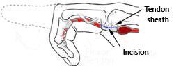 Durante l'intervento chirurgico, la puleggia tendinea vienesezionata.