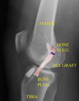 Radiografia post-operatoria dopo ricostruzione del LCA con tendine rotuleo (con foto del trapianto sovrapposto) che dimostra la posizione dell'innesto e delle bratte ossee fissate con viti a interferenza di metallo.