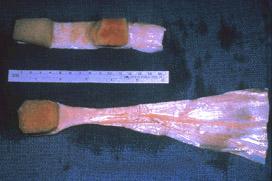 Allotrapianti di tendine rotuleo (in alto) e di tendine di Achille (in basso) prima della fase di preparazione per la ricostruzione del LCA.