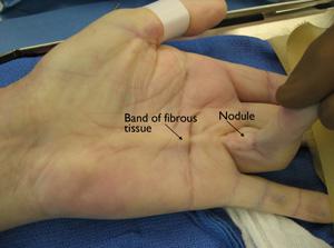 Il medico misura la flessione di un dito, e nota dove si trovano i noduli e le corde ditessuto. ﻿