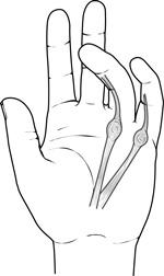 I sintomi della contrattura di Dupuytren includono protuberanze dolorose (noduli)sotto la pelle che si sviluppano in strette bande (corde) di tessuto, causando la flessione delle dita.