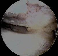Immagine artroscopica della cartilagine articolare del ginocchio danneggiata da un deficit del LCA.