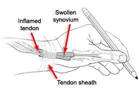 Tenosinovite di De Quervain del primo compartimentoestensore.