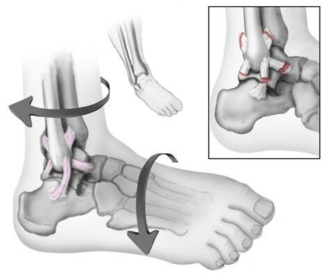 Una forza di torsione nella parte inferiore della gamba o del piede può provocare una distorsione. I legamenti laterali all'esterno della caviglia vengono più frequentemente lesionati.