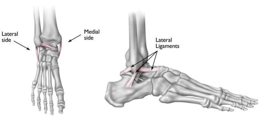Una distorsione alla caviglia è una lesione di uno o più legamenti che stabilizzano la caviglia.
